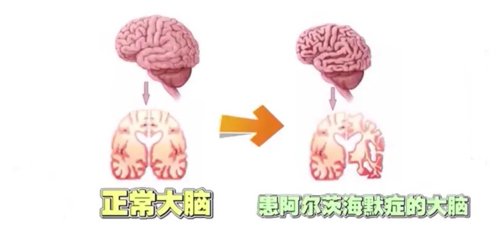 老年人的隐秘之敌，细数阿尔茨海默病的七个阶段